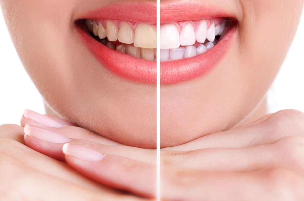 teeth whitening in borivali west