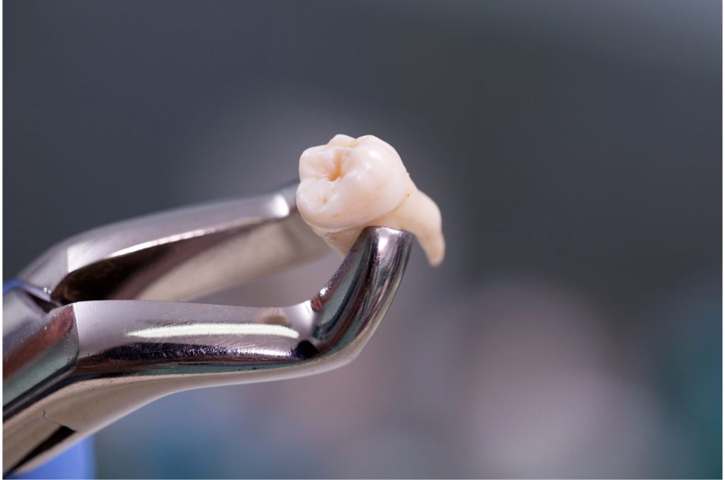 wisdom tooth removal in borivali west