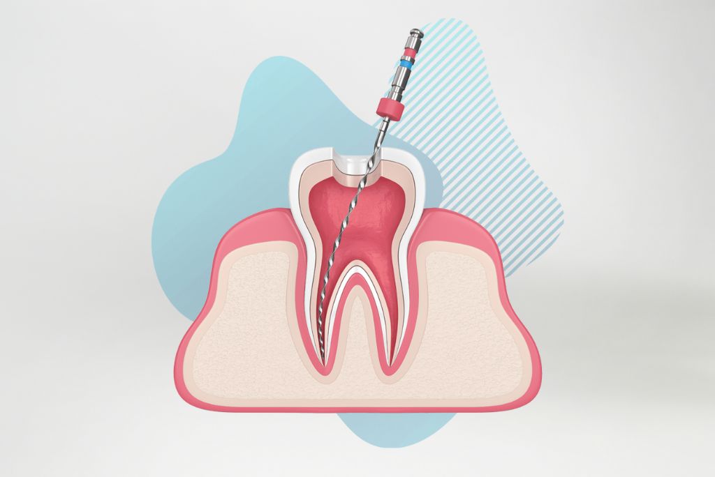 When to Consider a Root Canal: 5 Warning Signs